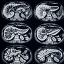 МРТ підшлункової залози